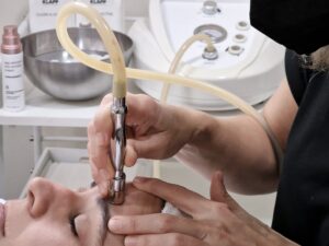 Tratamiento facial de dermoabrasión con punta de diamante en Gijón