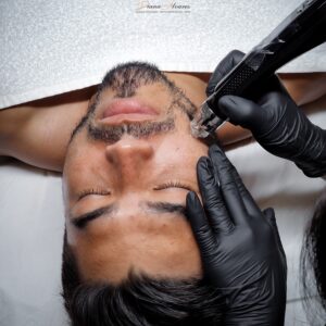 tratamiento marcas de acné con dermapen en Gijón