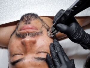 Tratamiento para el acné activo y las marcas de acné en Gijón con exosomas y dermapen con electroporación